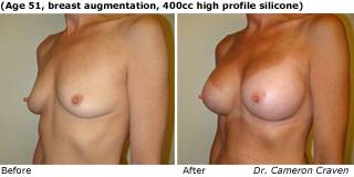 patient q breast augmentation quarter