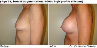patient Oq breast augmentation side