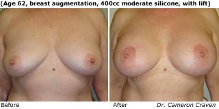 patient y breast augmentation front