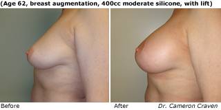 patient y breast augmentation side