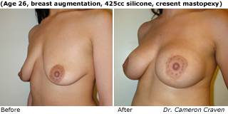 patient aa breast augmentation quarter