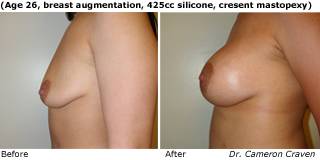 patient aa breast augmentation side