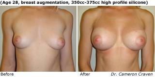 patient u breast augmentation front