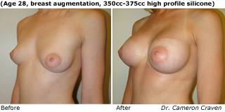 patient u breast augmentation quarter