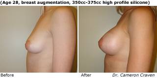patient u breast augmentation side