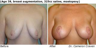 patient J breast augmentation front