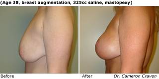 Patient J Silicone Before and After