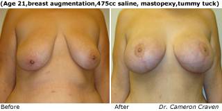 patient f breast augmentation front