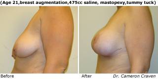 Patient f Silicone Before and After