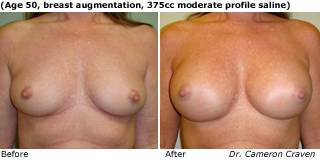 patient B breast augmentation front