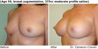 patient B breast augmentation qurter