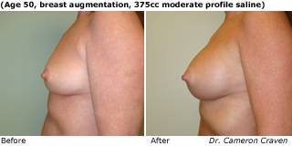 Patient B Silicone Before and After