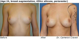 patient e breast augmentation front