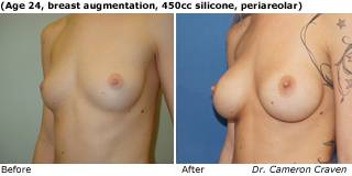 patient e breast augmentation quarter