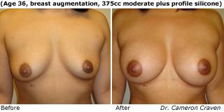 patient m breast augmentation front