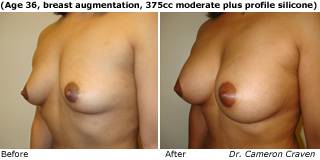 patient m breast augmentation quarter