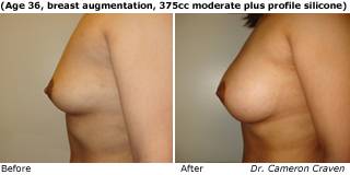 patient m breast augmentation side