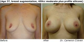 patient i breast augmentation front
