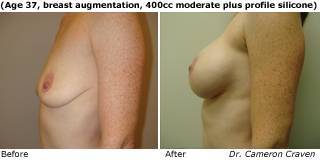 patient i breast augmentation side