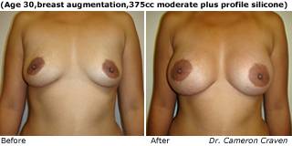 patient cc breast augmentation front