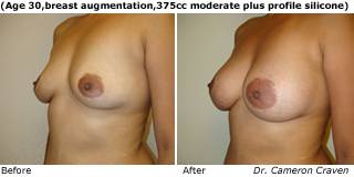patient cc breast augmentation quarter