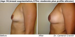 patient cc breast augmentation side