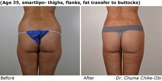 Patient D liposuction side view Before and After