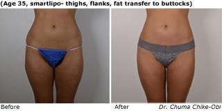 Patient D liposuction Before and After
