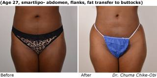 Patient Q liposuction Before and After