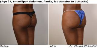 Patient Q liposuction up view Before and After