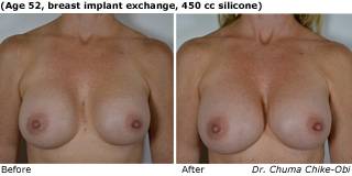 patient EE breast augmentation front