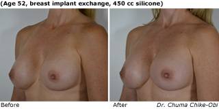 patient EE breast augmentation quarter