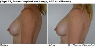 patient EE breast augmentation side