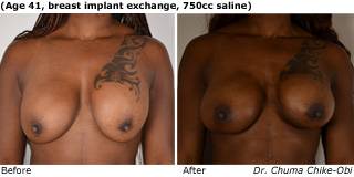 patient P breast augmentation front