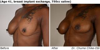 patient P breast augmentation qurter