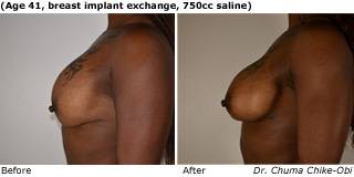 Patient P Silicone Before and After