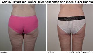 Patient B liposuction side view Before and After