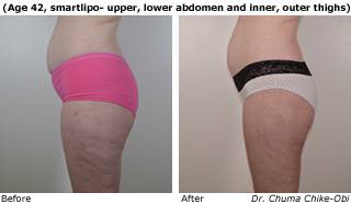 Patient B liposuction up view Before and After