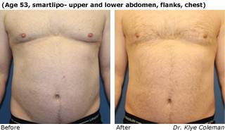 Patient P liposuction side view Before and After