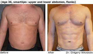 Patient L SmartLipo side view Before and After