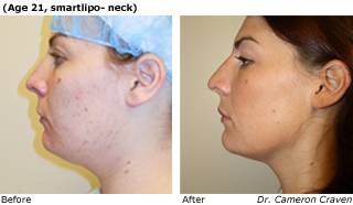 Patient J liposuction Before and After