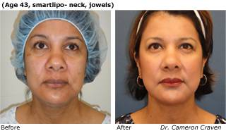 Patient C SmartLipo side view Before and After