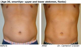 Patient H Smartlipo side view Before and After