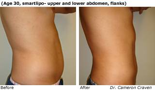 Patient H SmartLipo Before and After