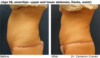 Patient F liposuction Before and After