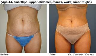 Patient C liposuction side view Before and After