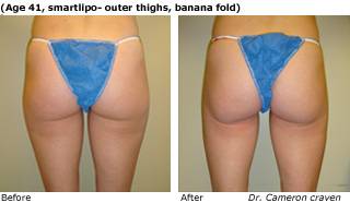 Patient N liposuction side view Before and After