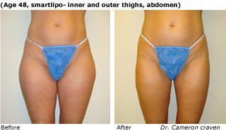 Patient A SmartLipo Before and After