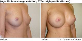 patient A breast augmentation quarter