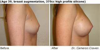 patient A breast augmentation side